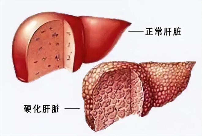 肝硬化乙肝患者千万别熬夜(图2)