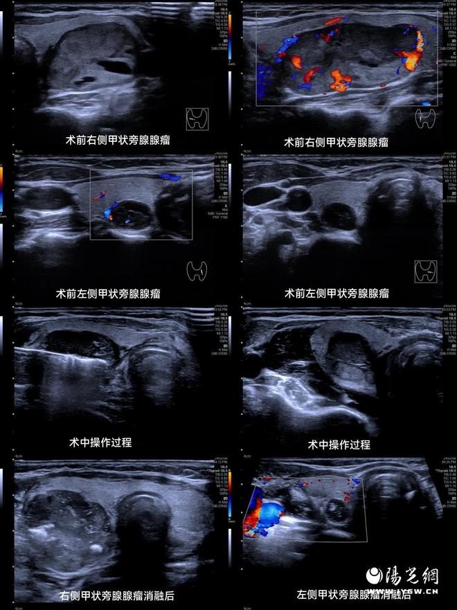 西安交大二附院开展首例妊娠期甲状旁腺腺瘤射频消融治疗(图2)