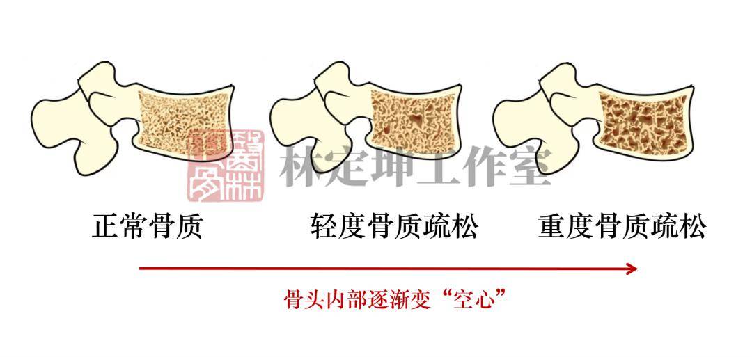 医林正骨丨偏爱中老年女性的3种关节疾病做好这些就能预防(图1)