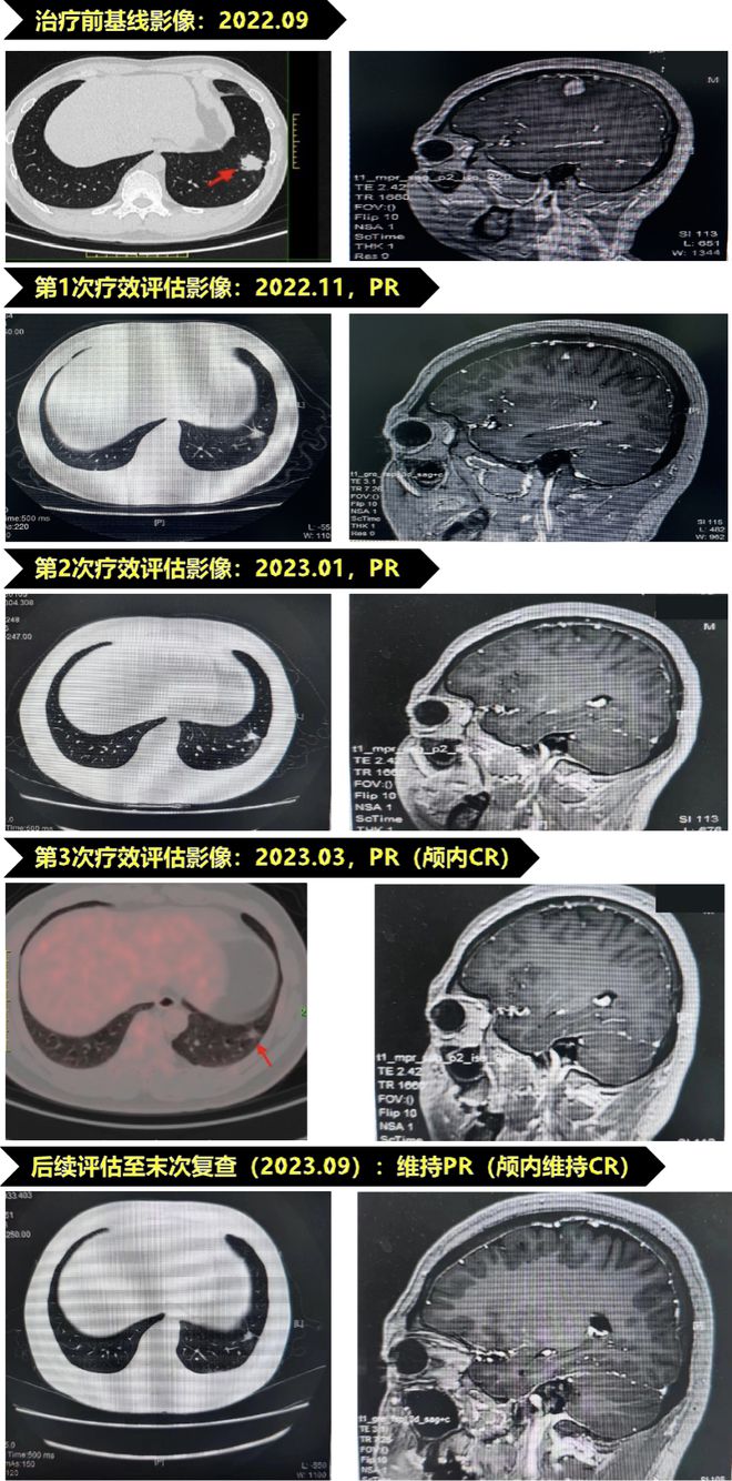 博采众长丨颅内CR年轻肺癌患者突破脑转移困境半岛bandao体育(图3)