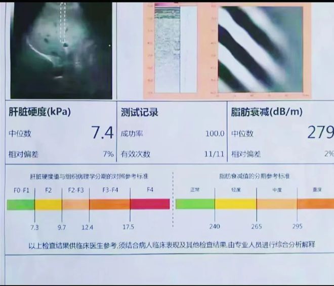 做好这3点山东大哥3年肝硬化1年轻半岛·BOB官方网站松逆转(图1)